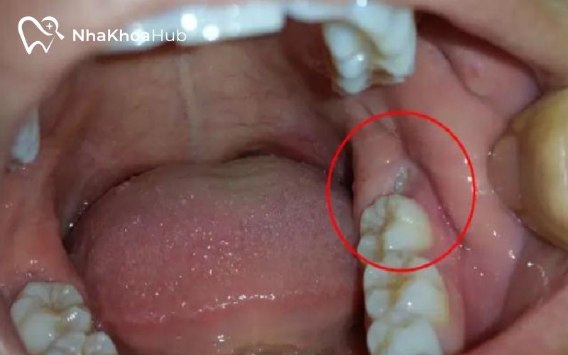 Sau 14 ngày nhổ bỏ răng, mô lợi gần như lành hẳn