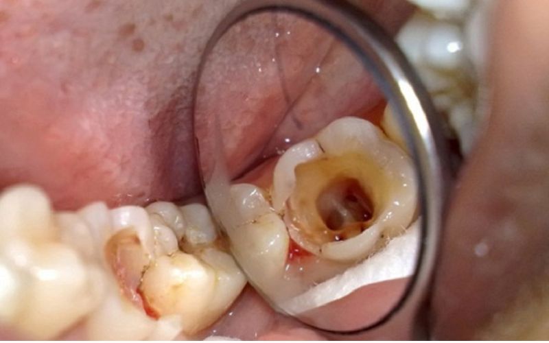 Tác hại của việc không nhổ răng sâu và cách xử lý an toàn Xác định đúng trường hợp để nhổ răng và biện pháp phòng tránh phù hợp để bảo vệ sức khỏe răng miệng