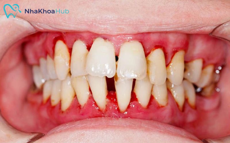 Tác hại của việc nhổ răng số 4 và cách xử lý an toàn Nhổ răng tiền hàm giúp ngăn ngừa viêm nhiễm lây lan khắp khoang miệng