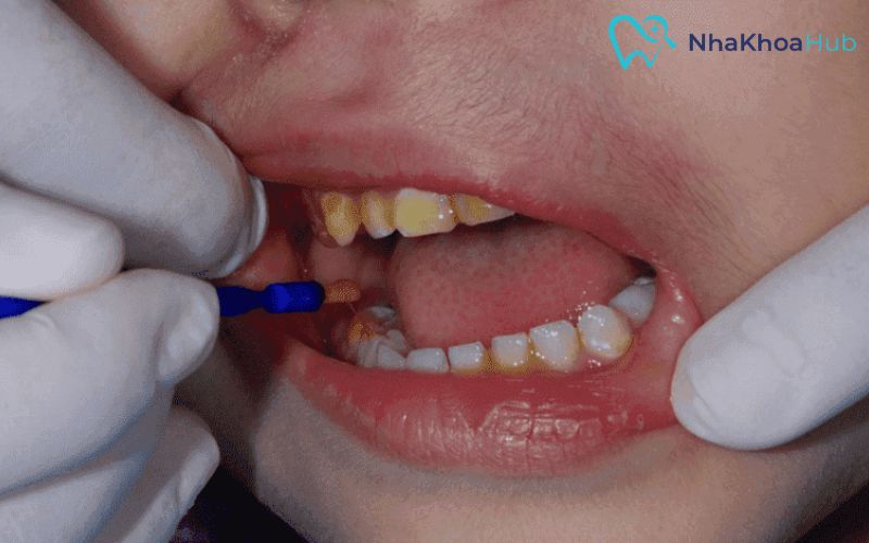 Review top 8 loại thuốc nhỏ răng sâu nổi bật trên thị trường Dùng thuốc nhỏ cho răng đúng cách sẽ hỗ trợ điều trị và đảm bảo an toàn cho cơ thể