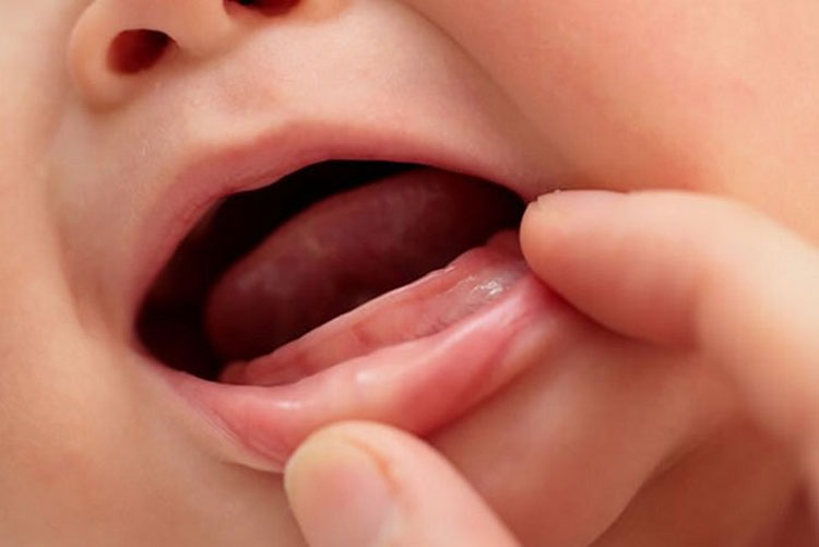 Bé chậm mọc răng là khi sau 12 tháng tuổi chưa có răng sữa
