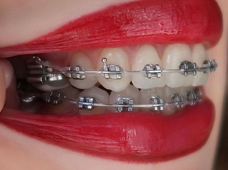 Niềng răng mắc cài kim loại là hình thức được sử dụng phổ biến