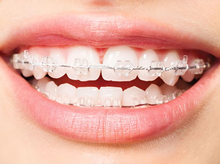 Niềng răng mắc cài sứ trùng khớp với màu răng, tăng tính thẩm mỹ