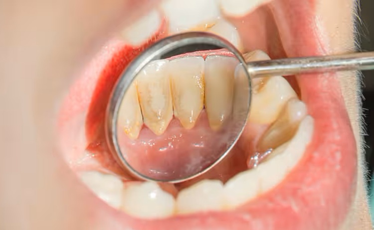 Dễ dàng quan sát cao răng màu vàng hoặc nâu trên bề mặt răng hoặc trên nướu