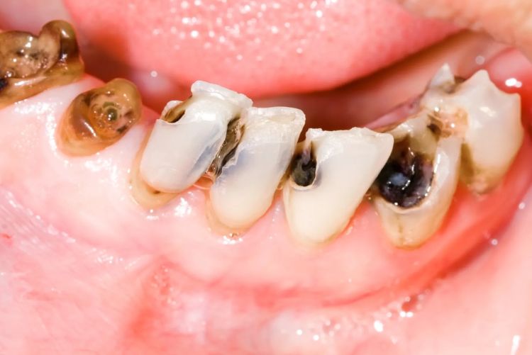 Cao răng màu đen: Nguyên nhân và cách điều trị triệt để Sâu răng tạo các đốm đen trên bề mặt răng