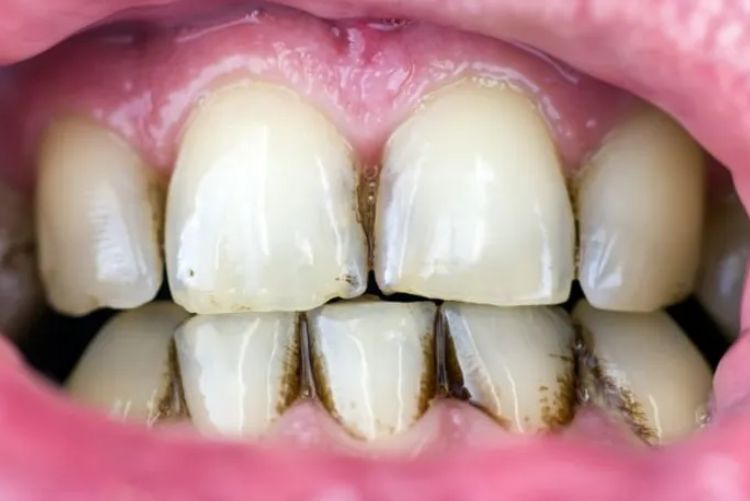 Cao răng màu đen: Nguyên nhân và cách điều trị triệt để Vôi răng đen do cặn bám lâu ngày