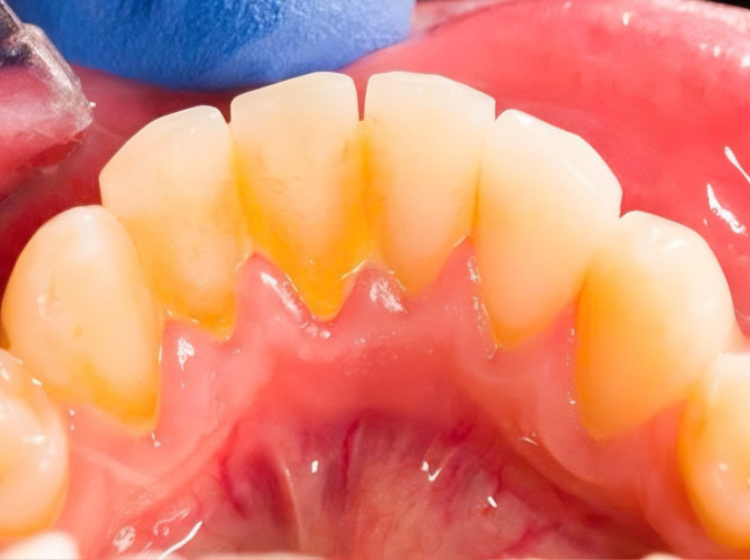 Cao răng tự rơi ra có tốt không? Nguyên nhân và lưu ý cần biết Cao răng là lớp mảng bám cứng trên bề mặt răng, tích tụ do cặn thức ăn còn sót lại