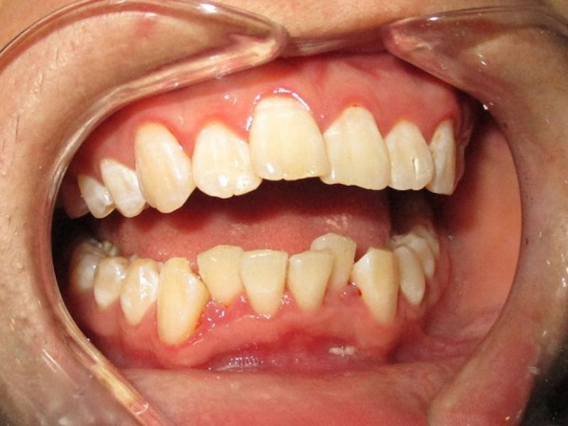 Dấu hiệu mọc răng khểnh dễ nhận biết sớm từ bác sĩ nha khoa Răng khấp khểnh ở người trưởng thành về lâu dài gây viêm lợi, sâu răng kẽ