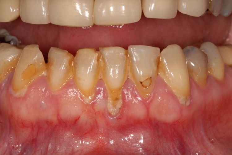 Cao răng tích tụ lâu ngày có thể gây viêm nha chu, làm suy yếu mô nâng đỡ răng và dẫn đến tụt nướu