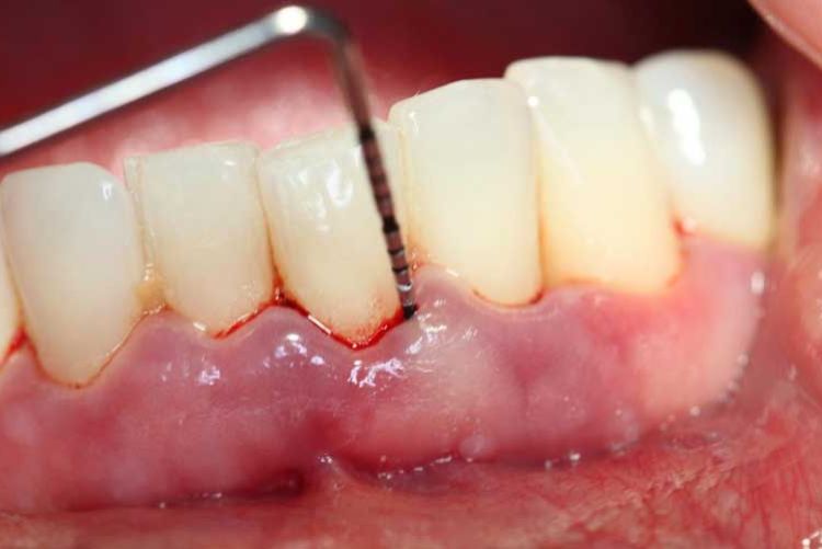 Lấy cao răng bị chảy máu có sao không? Nguyên nhân và giải pháp Làm sạch cao răng bị chảy máu cần kiểm tra kỹ