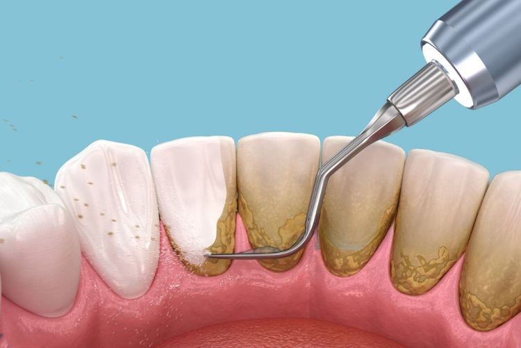 Cạo cao răng không đau vì dụng máy siêu âm chuyên dụng