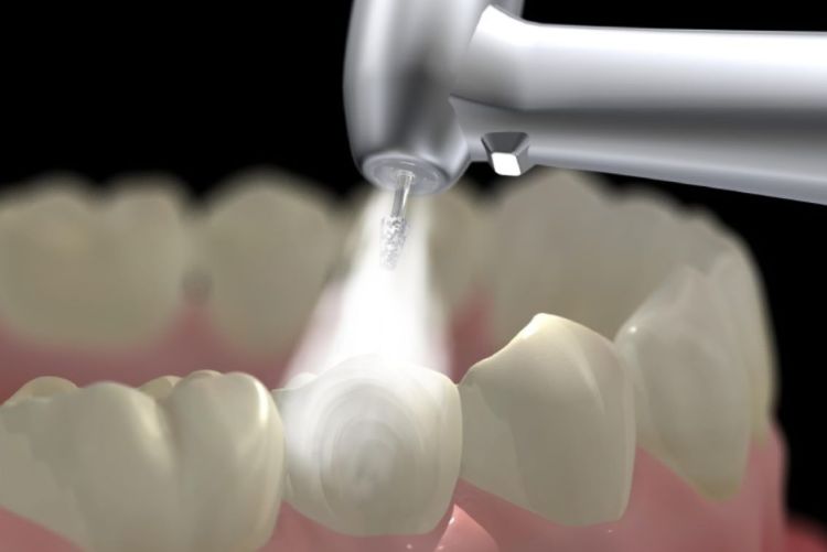 Ưu tiên cạo vôi răng bằng sóng siêu âm để giảm ê răng