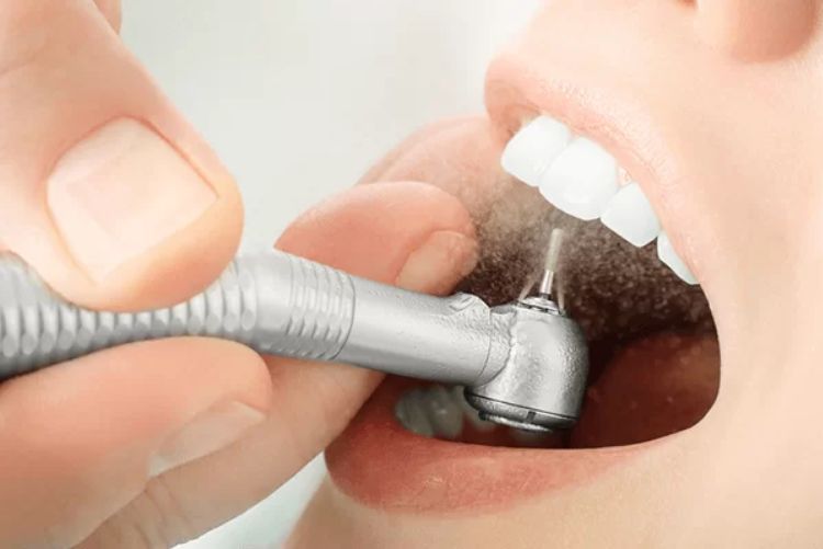 Cạo cao răng có đau không là câu hỏi thường gặp tại các phòng khám răng
