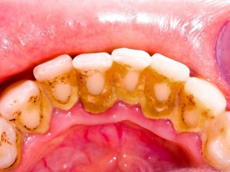 Lấy cao răng và tẩy trắng răng là hai kỹ thuật hoàn toàn khác nhau