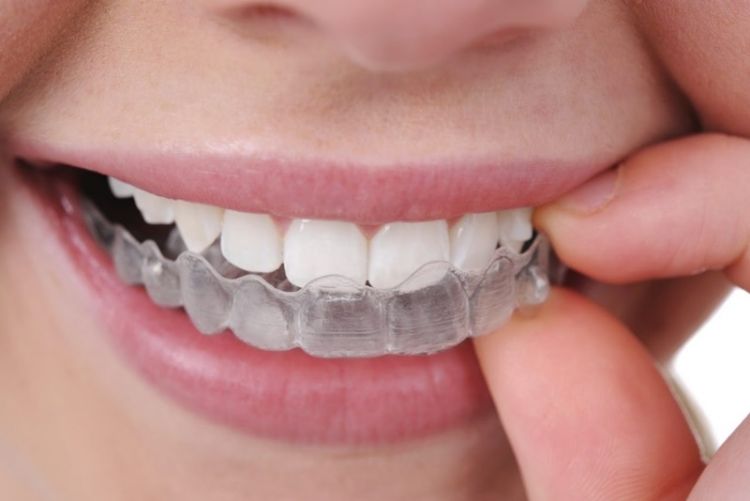Bật mí những điều bạn nên biết về máng tẩy trắng răng Tháo khay ngậm và vệ sinh răng miệng theo hướng dẫn