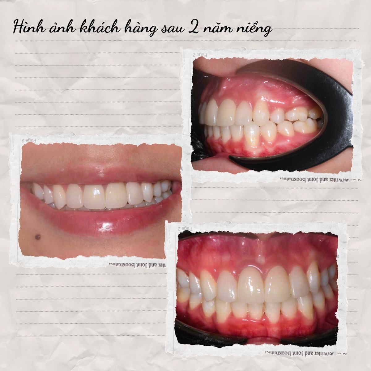 Nha khoa Quốc An – Phòng khám uy tín, đặt lịch khám nhanh Mỗi lần tái khám, Thu đều được kiểm tra cẩn thận, điều chỉnh lực kéo phù hợp và hướng dẫn chăm sóc răng miệng đúng cách để tránh viêm lợi, sâu răng hay bung mắc cài