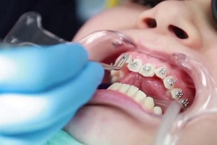 Những điều bạn cần biết về nhật ký niềng răng Nhật ký là công cụ giúp cá nhân hóa phương án niềng răng