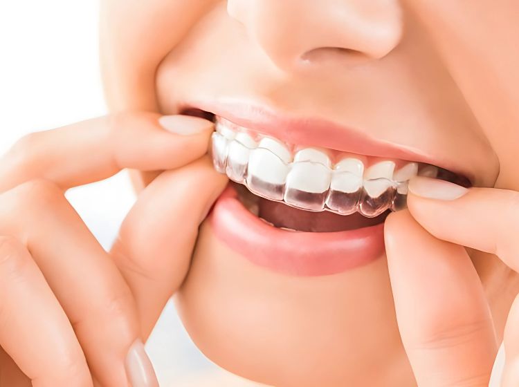 Hiện nay, niềng răng trong suốt Invisalign là giải pháp được nhiều người ưa chuộng