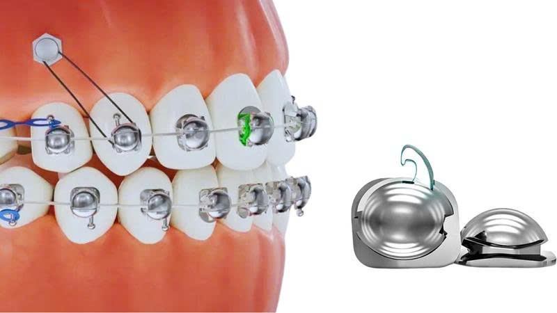 Niềng mắc cài cánh cam là phương pháp hiện đại, không cộm cấn, ma sát