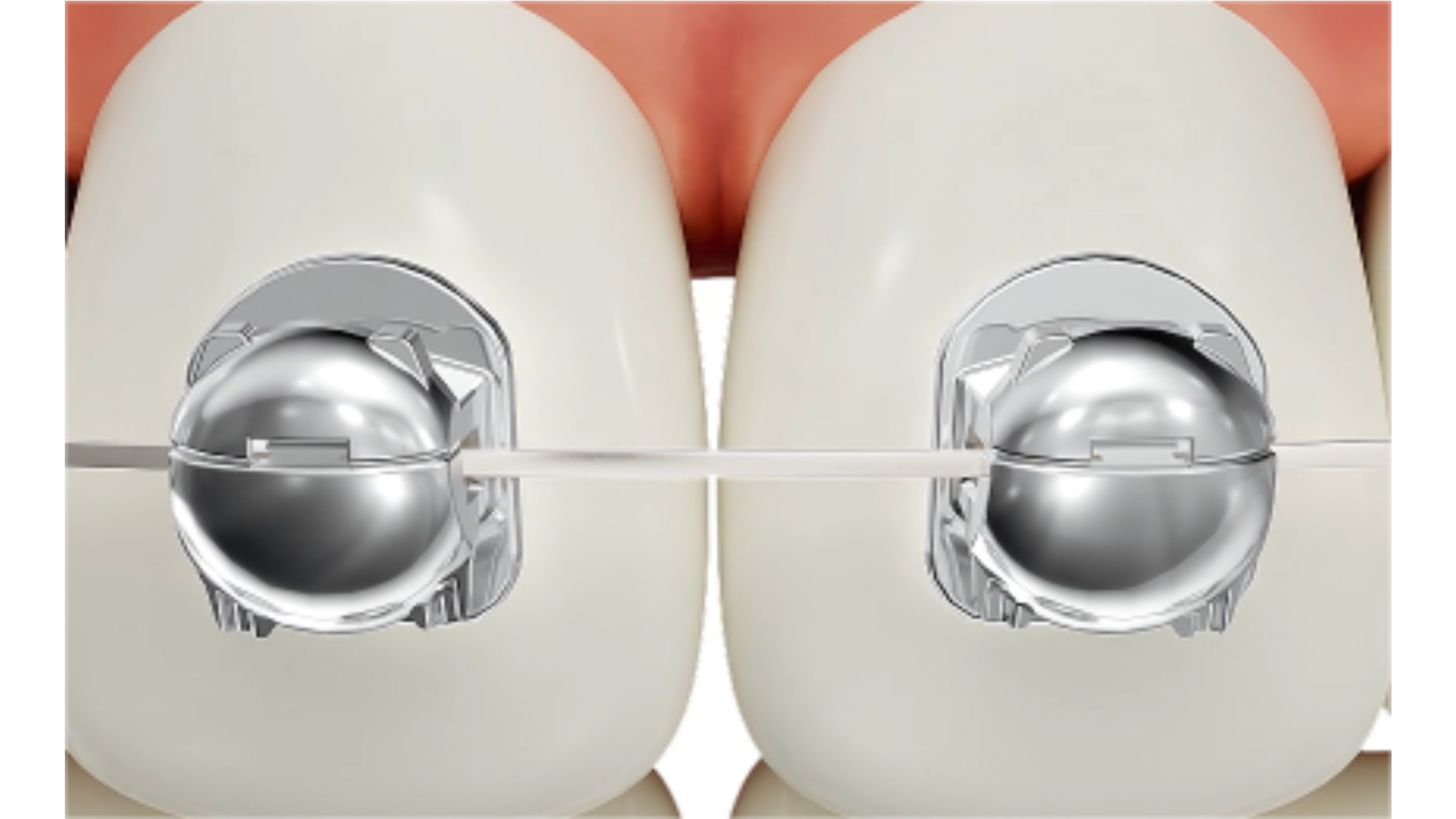 Thiết kế đặc biệt với phần đế hình cánh cam, mang đến một lực tác động ổn định giúp di chuyển răng đến vị trí mong muốn