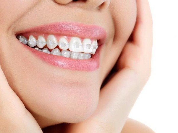Bật mí ưu nhược điểm và chi phí niềng răng mắc cài pha lê Mắc cài pha lê trong suốt giúp tăng tính thẩm mỹ khi niềng răng