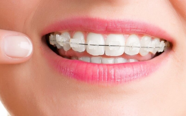 Niềng răng mắc cài sứ được nhiều người lựa chọn nhờ sở hữu các ưu điểm vượt trội