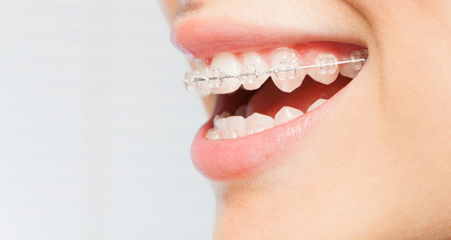 Có 2 loại niềng răng mắc cài sứ phù hợp với nhiều đối tượng khác nhau