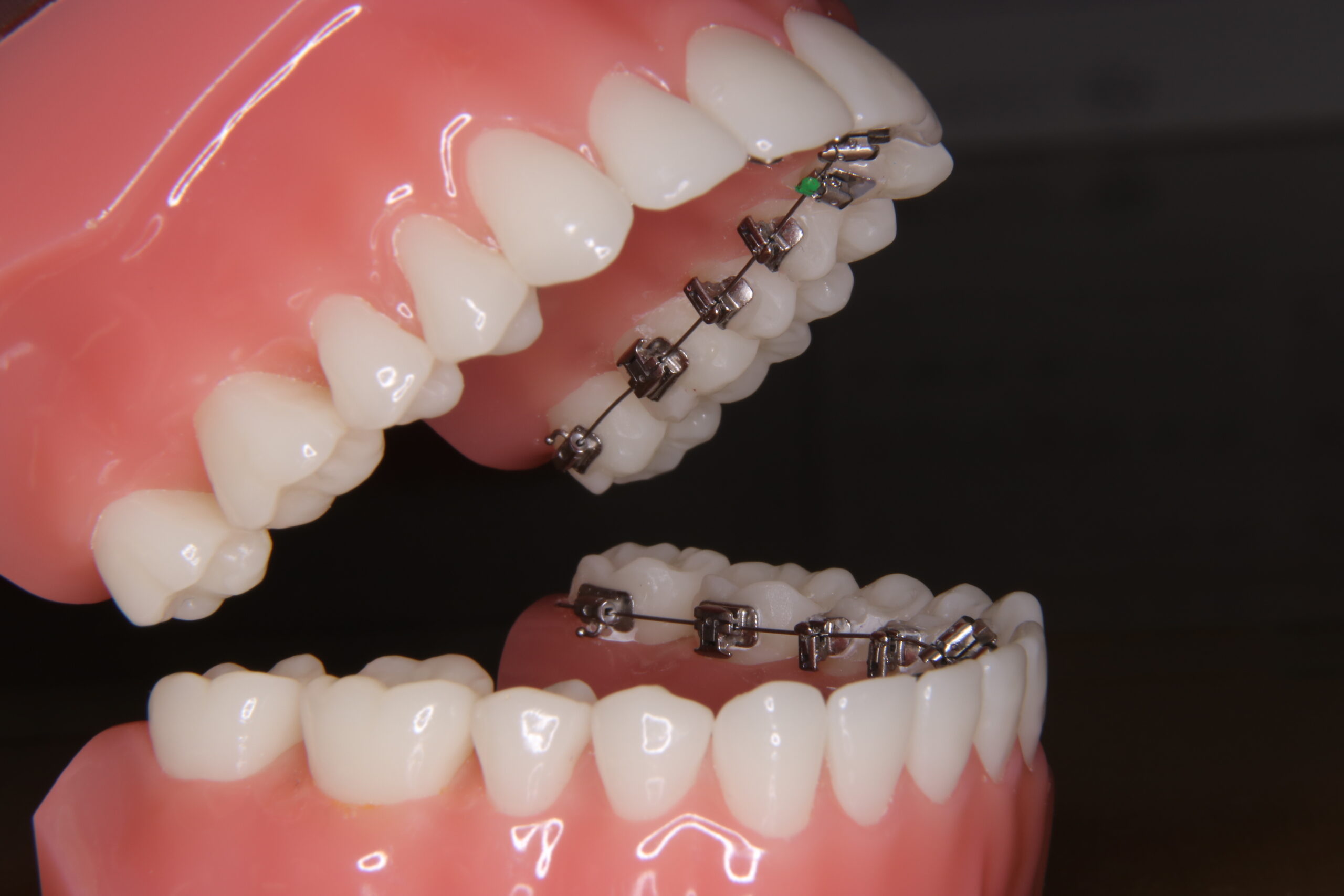 Tất tần tật những điều bạn nên biết về niềng răng mặt lưỡi Niềng răng mắc cài trong lưỡi sở hữu nhiều ưu điểm