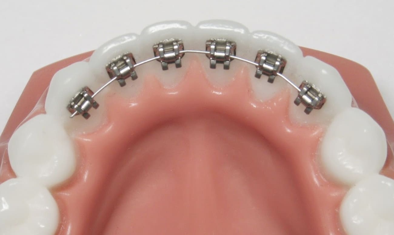 Tất tần tật những điều bạn nên biết về niềng răng mặt lưỡi Niềng răng mặt lưỡi giúp nhiều người sở hữu hàm răng đều đẹp