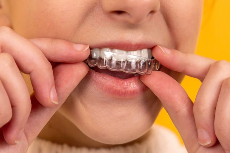 Niềng răng nhanh nhất mất bao lâu? Cách rút ngắn thời gian Niềng răng Invisalign chỉ phù hợp với răng lệch nhẹ