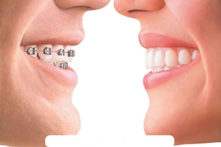 Niềng răng nhanh nhất mất bao lâu? Cách rút ngắn thời gian Chỉnh nha trong thời gian ngắn là mong muốn của nhiều người