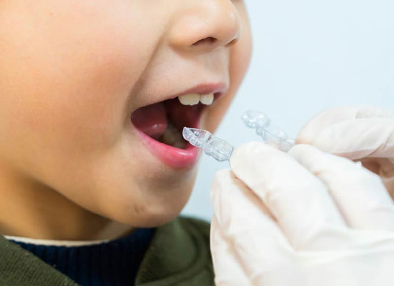 Niềng răng trong suốt trẻ em hiện là phương pháp chỉnh nha được nhiều phụ huynh ưa chuộng
