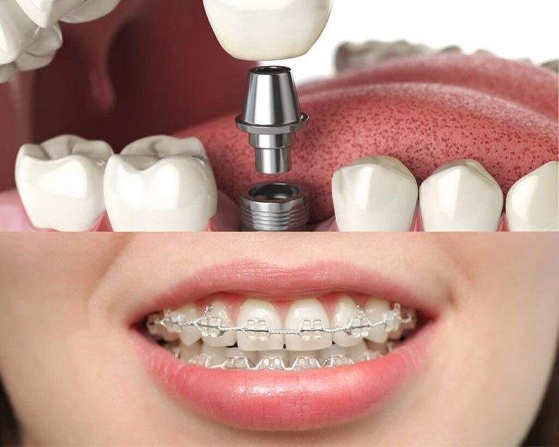 Răng implant có niềng được không phụ thuộc vào tình trạng răng của mỗi cá nhân và chỉ định của nha sĩ