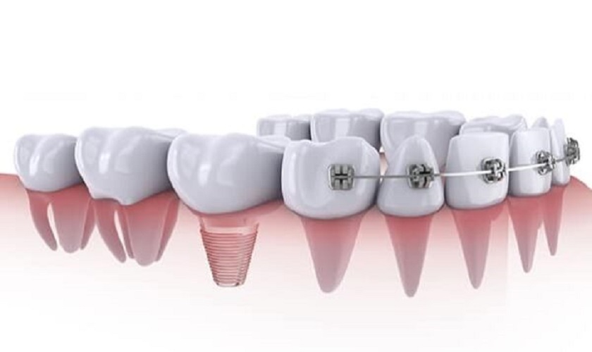 Trường hợp răng implant không ảnh hưởng đến vùng cần niềng thì có thể niềng răng 