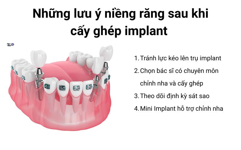 Lưu ý khi niềng răng sau cấy ghép Implant