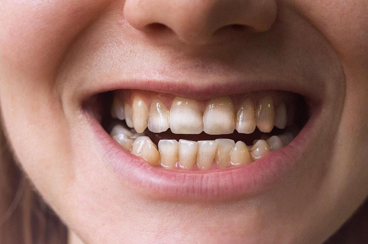 Những tác hại của tẩy trắng răng có thể bạn chưa biết Nguy cơ răng không đều màu sau khi tẩy ố răng