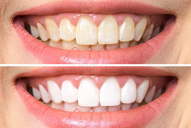 Tẩy ố răng cải thiện màu sắc răng trắng sáng hơn