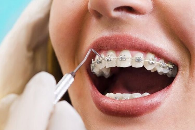 Chân răng chắc chắn, không xô lệch có thể cân nhắc gỡ khí cụ