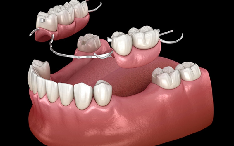 Hàm giả tháo lắp là phương pháp phục hình răng phổ biến, đặc biệt phù hợp với những trường hợp mất nhiều răng hoặc mất răng toàn hàm