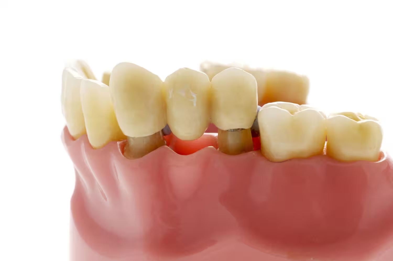 Cầu răng sứ là phương pháp phục hình răng mất bằng cách sử dụng các răng kế cận làm trụ đỡ
