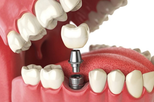 Cấy ghép Implant là phương pháp trồng răng giả tiên tiến nhất hiện nay, giúp thay thế hoàn toàn cả chân răng và thân răng đã mất
