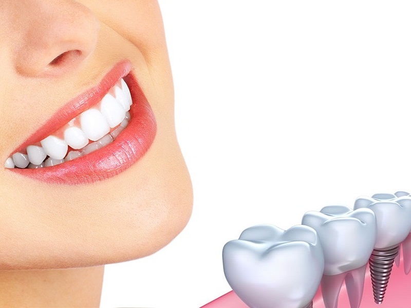 Cấy răng implant không chỉ giúp khôi phục chức năng ăn nhai như răng thật mà còn mang lại tính thẩm mỹ cao và ngăn ngừa tình trạng tiêu xương hàm
