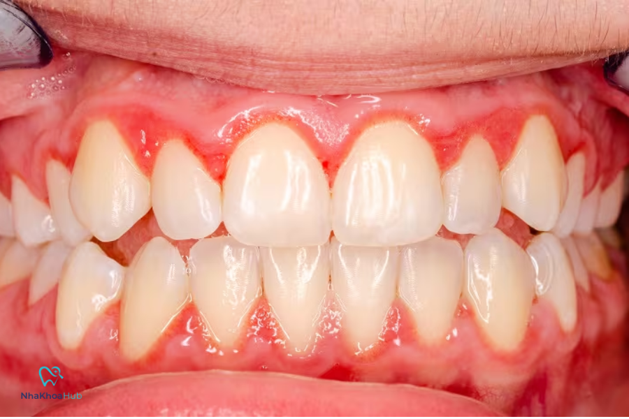Nguyên nhân và cách điều trị tình trạng viêm nướu răng an toàn Viêm nướu răng không chỉ là vấn đề thẩm mỹ mà còn ảnh hưởng nghiêm trọng đến sức khỏe toàn thân