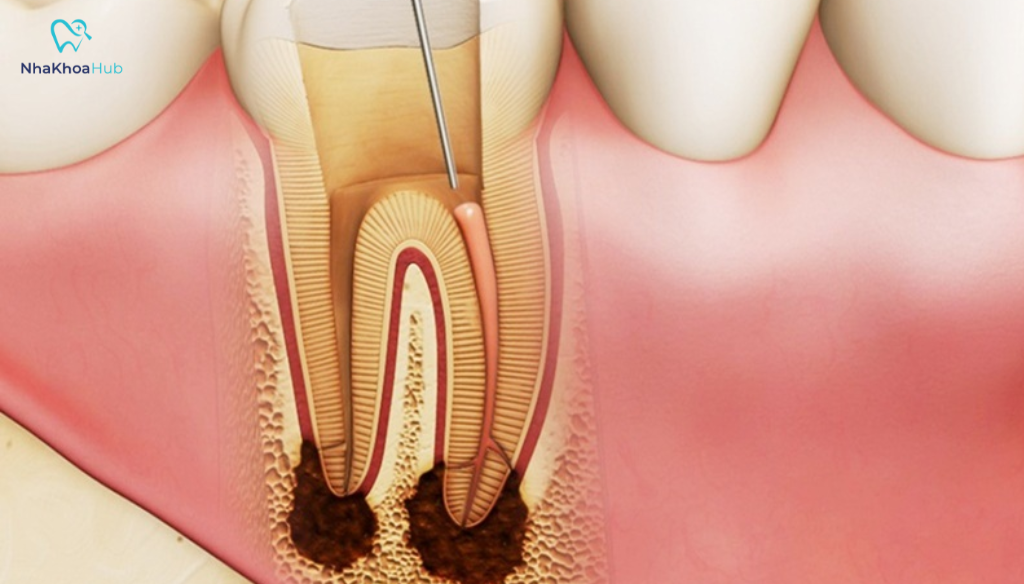 Viêm tủy răng nên ăn gì để hỗ trợ điều trị nhanh hồi phục? Chế độ dinh dưỡng hợp lý giúp giảm triệu chứng đau và hỗ trợ răng, nướu hồi phục nhanh hơn