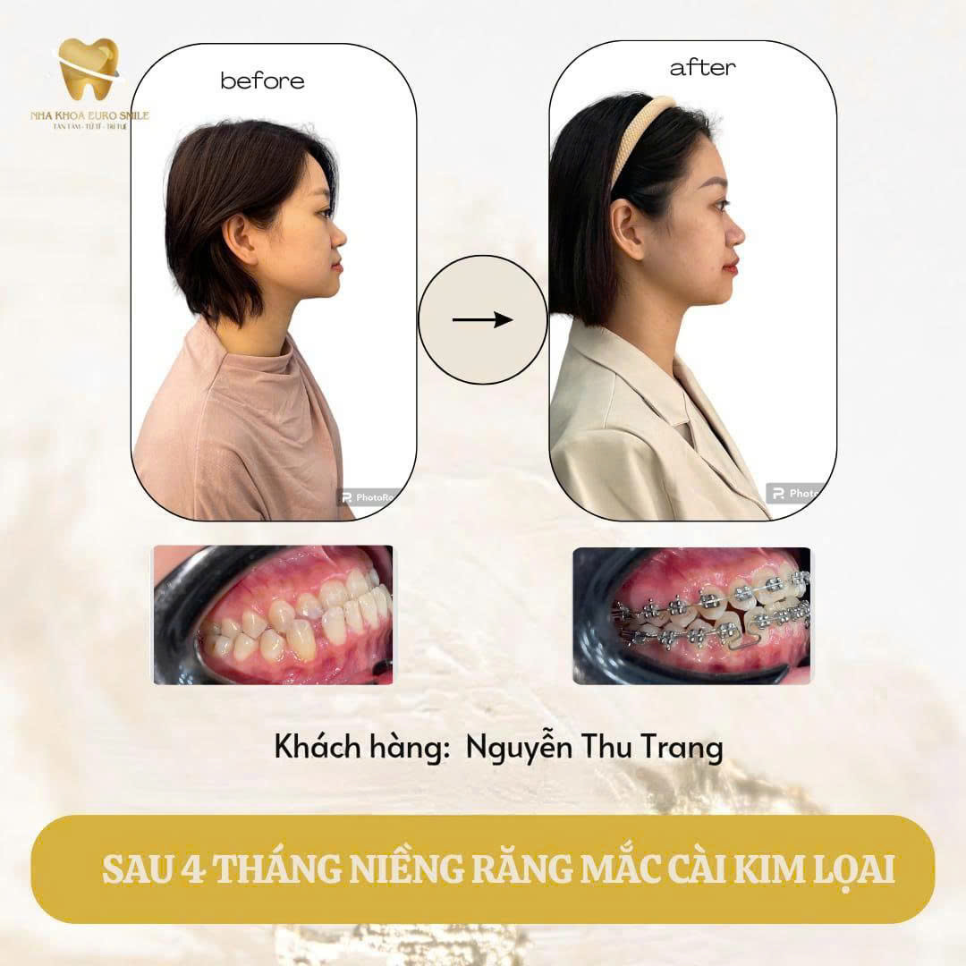 Hàm răng của chị Trang đều tăm tắp, khuôn mặt trở nên hài hòa, nụ cười rạng rỡ hơn bao giờ hết