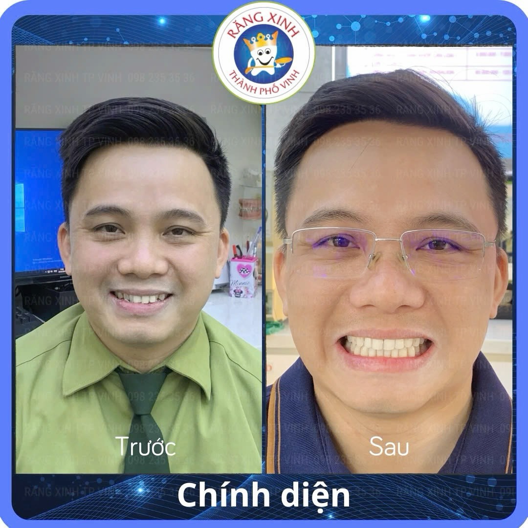 Nha khoa Răng Xinh - Địa chỉ điều trị răng miệng toàn diện tại Nghệ An Anh Hưng đã có bộ răng sứ mới, màu sắc tự nhiên, ôm khít nướu và cảm giác ăn nhai thoải mái như răng thật