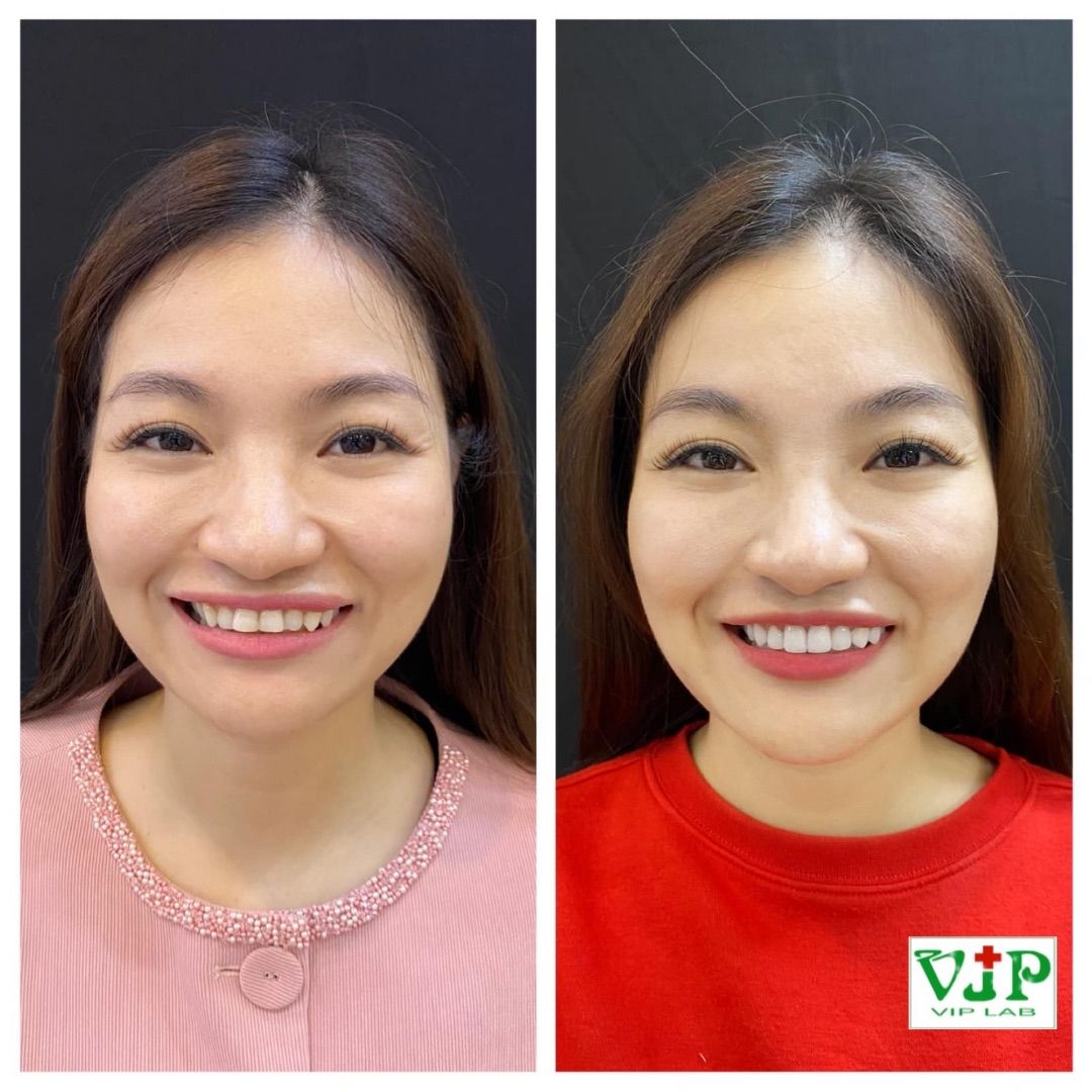 Sau khi hoàn thiện, răng chị Mai trắng sáng, đều đẹp, khuyết điểm cũ biến mất hoàn toàn