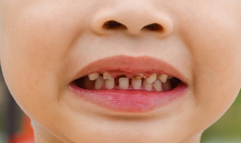 Người có bệnh lý về răng cần điều trị trước khi điều trị chỉnh nha