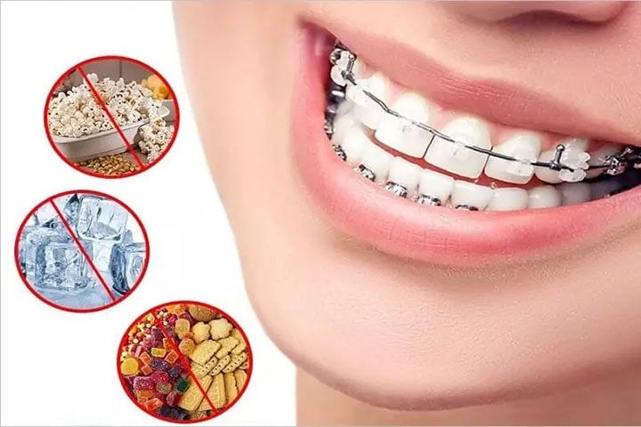 Bạn nên tránh thức ăn cứng, dính, dễ mắc vào mắc cài hoặc làm bung khí cụ