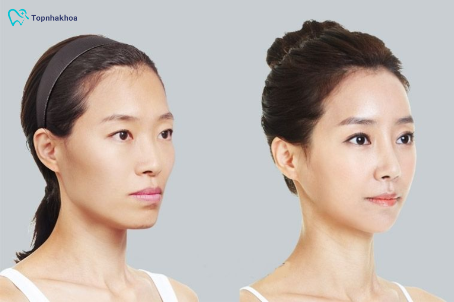 Giai đoạn xấu nhất khi niềng răng là khi nào? Cách xử lý Mặc dù thẩm mỹ tạm thời bị ảnh hưởng nhưng đây là bước bắt buộc để đạt được kết quả chỉnh nha hoàn hảo về sau